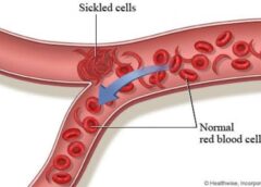 Revolutionizing Fibromyalgia Treatment: How Stem Cell Therapy is Changing Lives