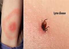 Lyme Disease vs Fibromyalgia: Symptoms, Diagnosis, and Treatment