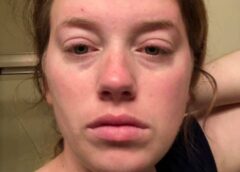 Living with Fibromyalgia: The Invisible Battle Nobody Sees