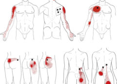 Does anyone else with fibro deal with shoulder blade pain? One or both?