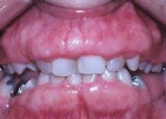 Fibromyalgia and Dental Issues
