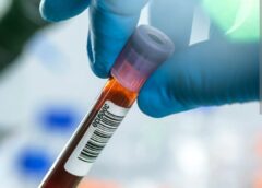 Blood Test for Fibromyalgia:What You Must Understand Check Out this post Detail