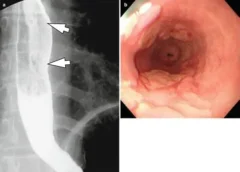 Acid Reflux and Fibromyalgia: Understanding the Connection