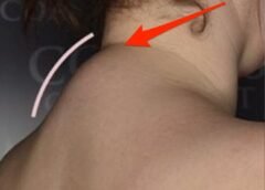 8 Facts You Probably Don’t Know About Fibromyalgia