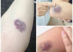 Can someone help or can anyone relate. I keep getting bruises that appear. I have not bumped into anything. Since having fibromyalgia I keep getting these bruises.