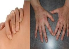 How to tell the difference between fibromyalgia & lupus