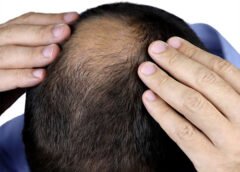 Lupus Patients Who Experience Hair Loss Might Have Higher Disease Activity