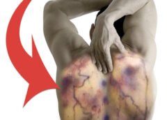 16 Ways to Imagine What Fibromyalgia Disorder Feels Like