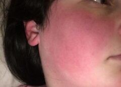 What Are the First Signs of Fibromyalgia: A Complete Guide 