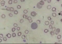 Folic acid supplementation and malaria susceptibility and severity among people taking antifolate antimalarial drugs in endemic areas