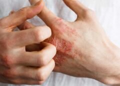 How to Treat Skin Rashes in Fibromyalgia